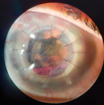 Cornea Image