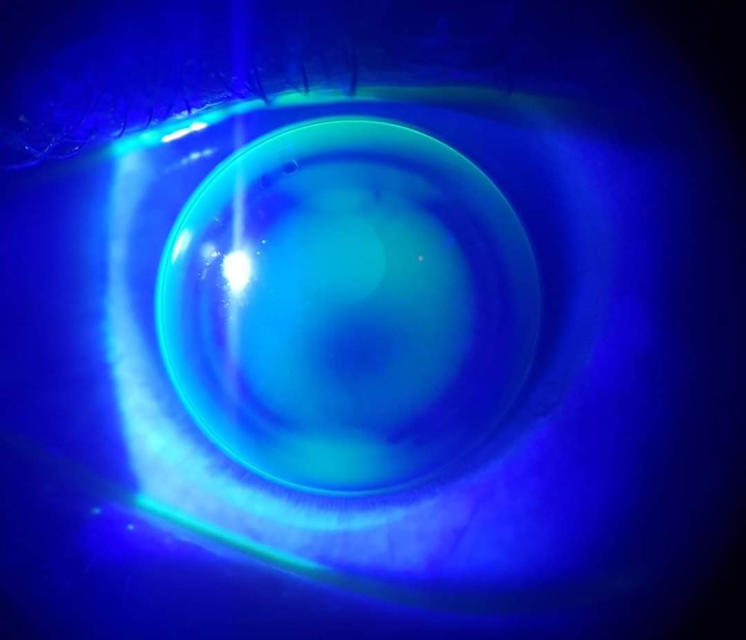 Cornea Image